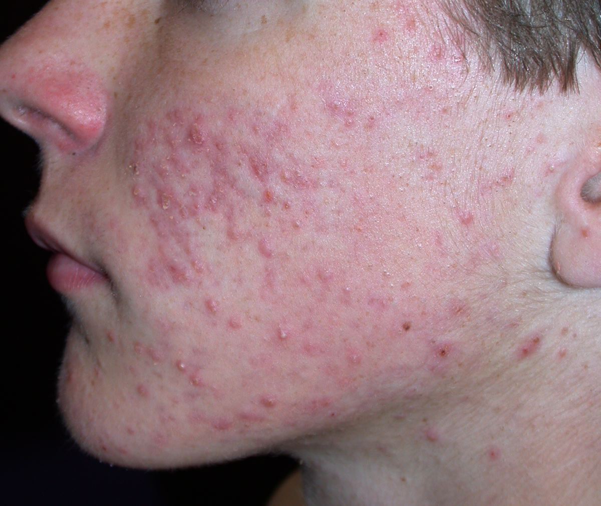 acne-face-2-18.jpg