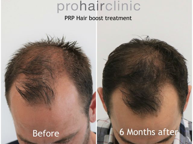 _dieter-v-pr-hair-boost-frontal-area.jpg