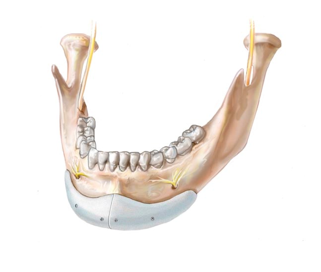 chin-implant2.jpg