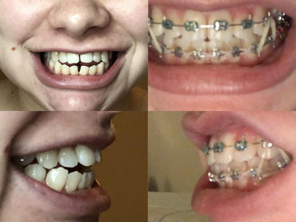 The day I got them put on and 10 months later. Only 8 more to go !: braces