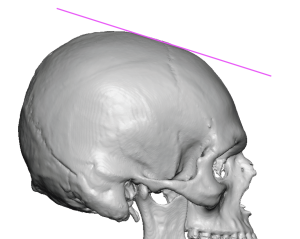 skull-forehead-slope-deformity-3D-CT-scan-side-view-Dr-Barry-Eppley-300x239.png