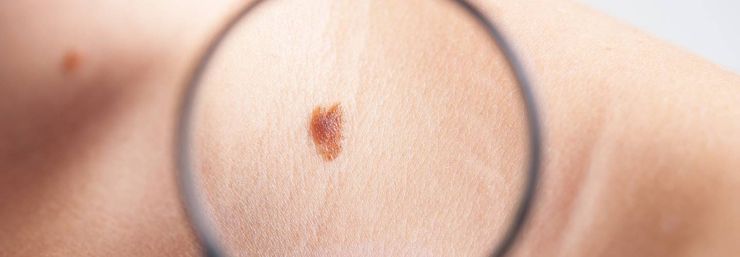 Looking-out-for-skin-cancer.jpg