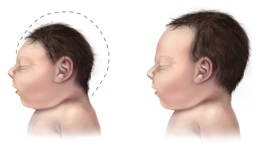 Microcephaly-comparison-500px.jpg