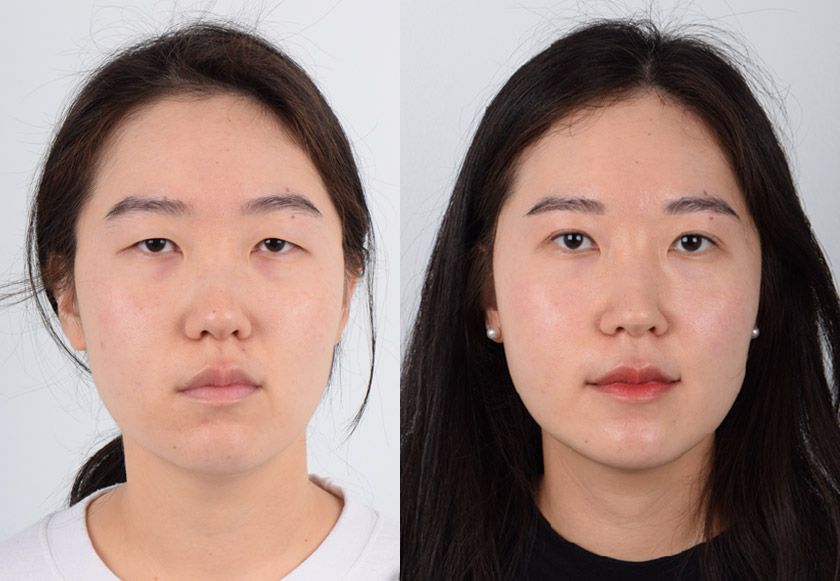 Double Eyelid Surgery Before and After Photo Gallery | Dr. Kenneth Kim