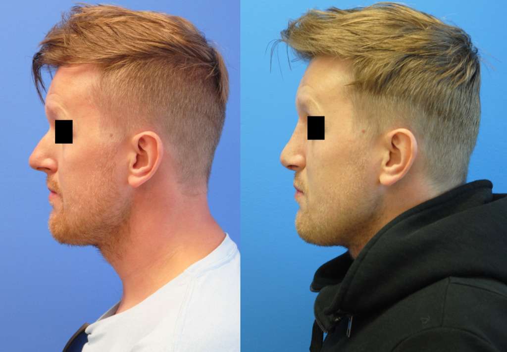 radix-graft-tip-deprojection-rhinoplasty-newport-beach.jpg