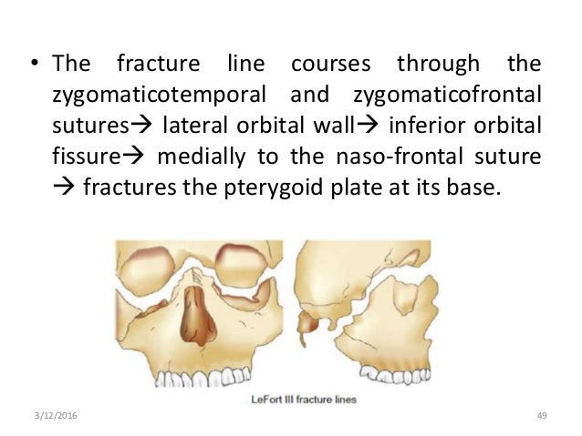 mid-facial-fractures-and-their-management-49-638.jpg