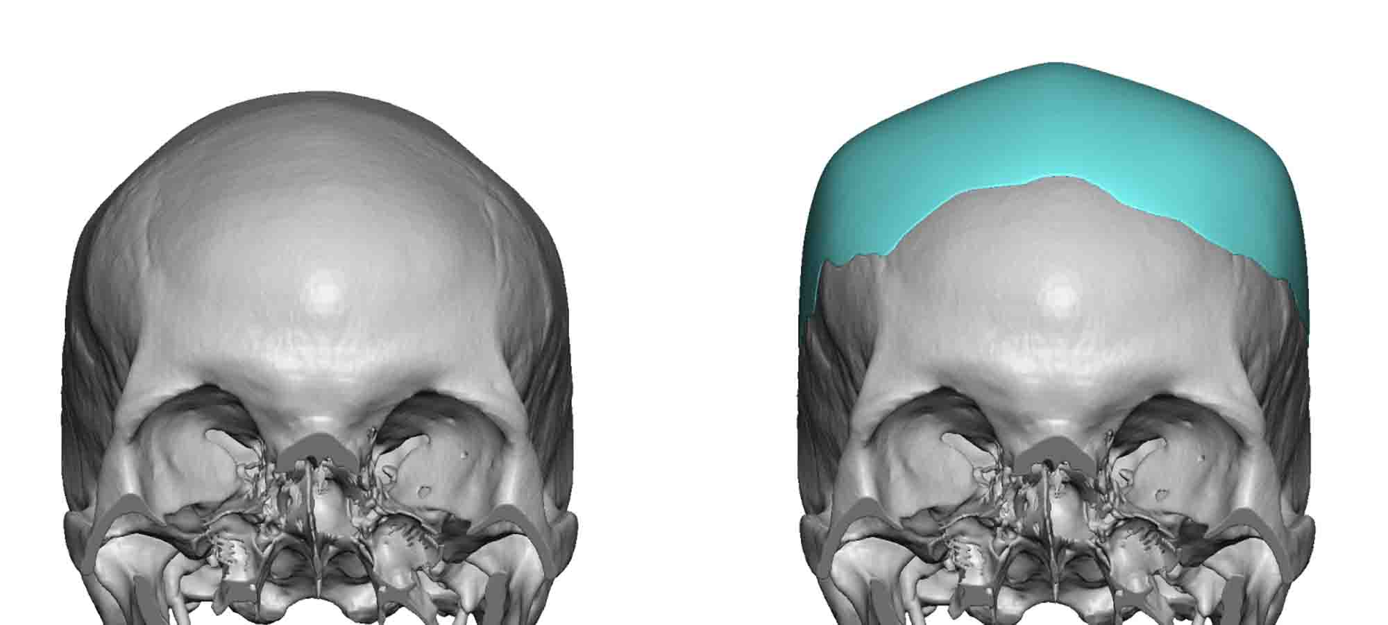 Square-Custom-Skull-Implant-design-Dr-Barry-Eppley-Indianapolis.jpg