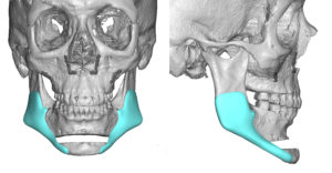 Sliding-Genioplasty-and-Custom-Jaw-Angles-design-Dr-Barry-Eppley-Indianapolis-300x156.jpg