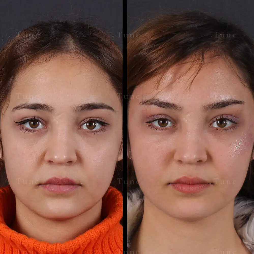 cropped-temporal-lift-6-1.webp