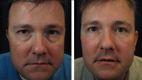 Filler.Lips_.UnderEyes.jpg