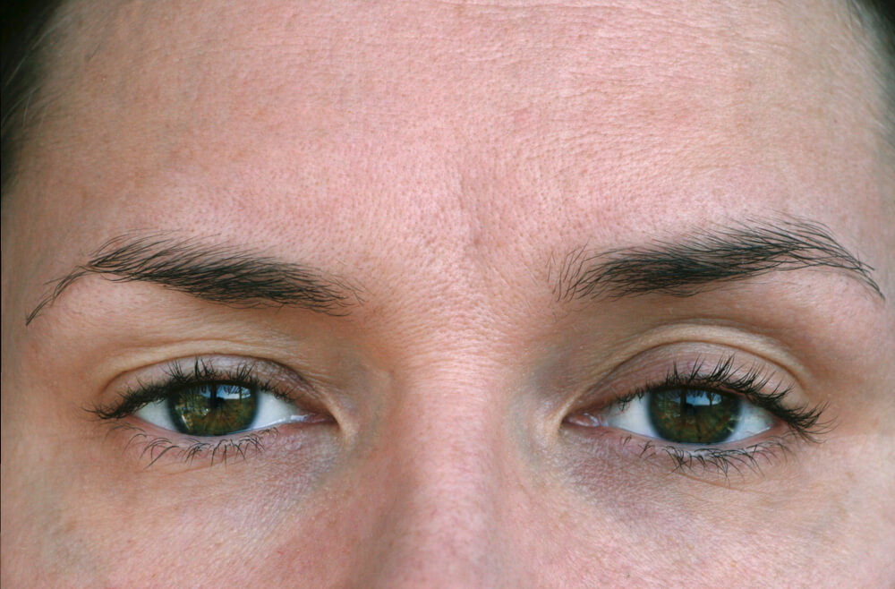 ptosis.jpg