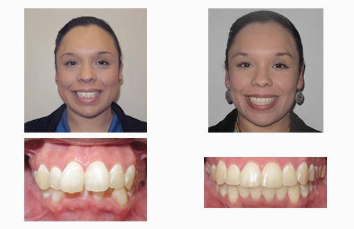 Self-Ligating Braces: What Are They, Benefits & Costs
