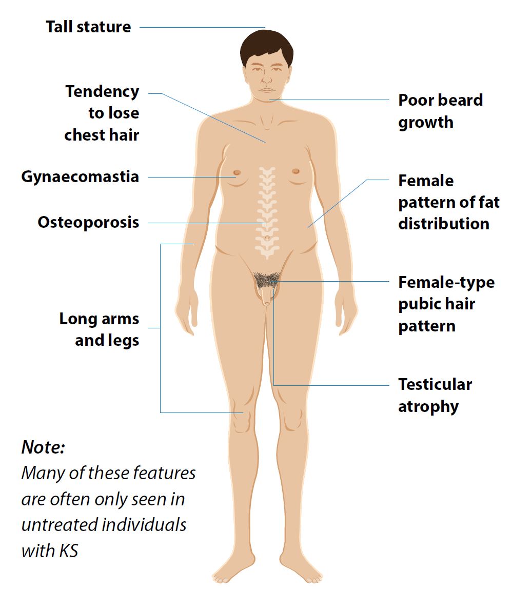 Klinefelter Syndrome