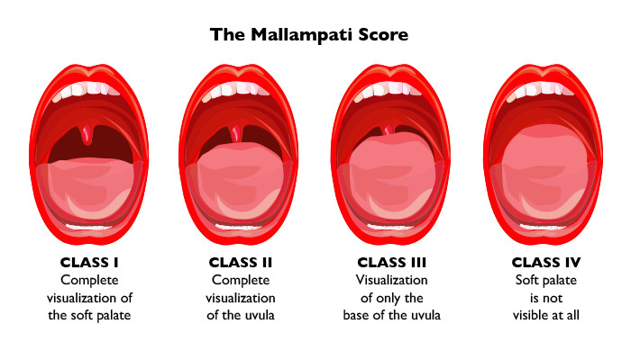 mallampatiscore_913672.jpg