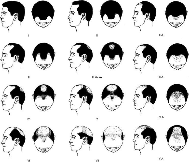 [Image: norwood-scale-for-men.jpg]