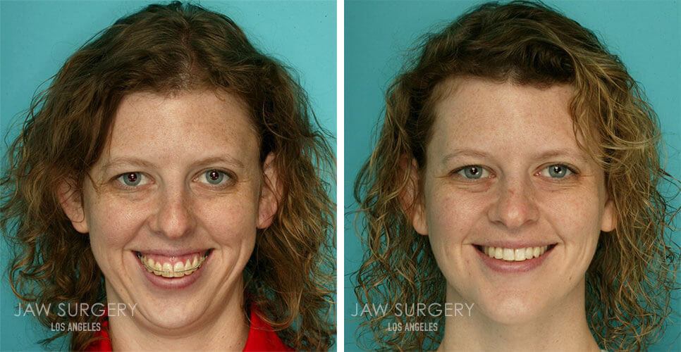 before-after-patient-03b.jpg