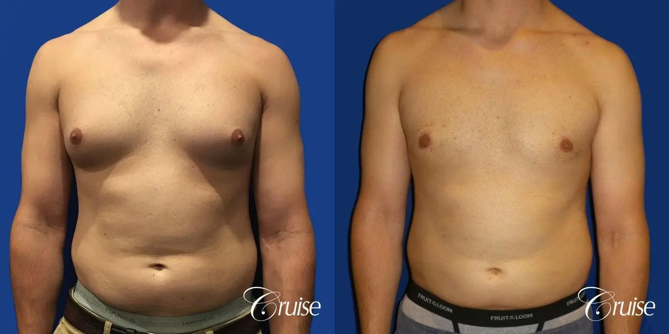 gynecomastia-before-and-after-7xVwpqv2c1Zm_highres.webp