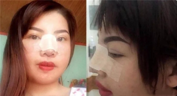 A young Vietnamese girl who spent huge sums of money on plastic surgery to marry a rich second generation and was dumped after marriage and giving birth