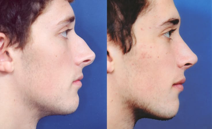 734cddd5962e16616c60ce1959774420--nose-jobs-rhinoplasty.jpg