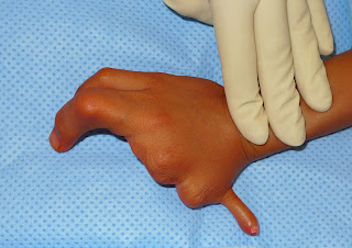 congenitalhand.wustl.edu
