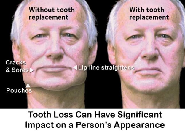 Face-with-Tooth-Replacement-624x441.jpg