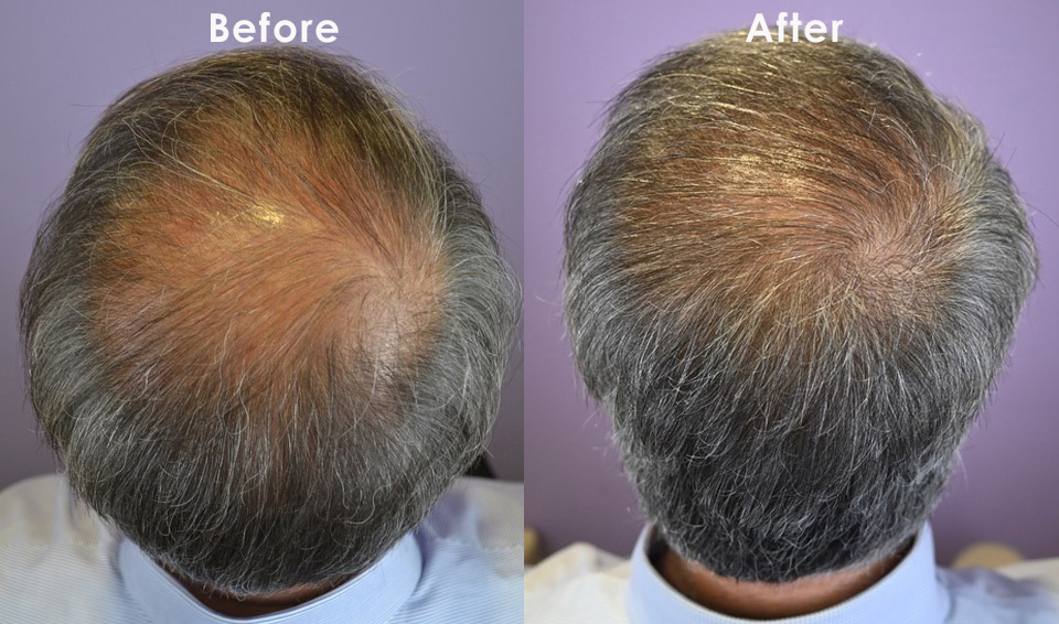 64-Before-After-Crown-Top.jpg