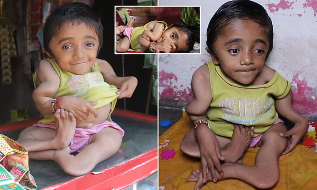 Rohit, 12, suffers terrible pain most of the day due to osteoporosis but it doesn't stop