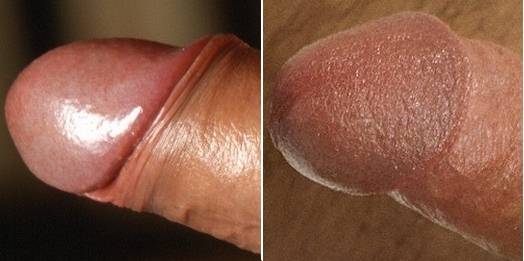 glans-i-c.jpg