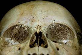This is what bone cancer of the skull looks like. NOPE. : r/WTF