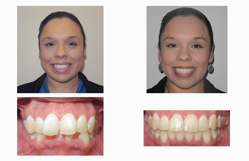 Self-Ligating Braces: What Are They, Benefits & Costs