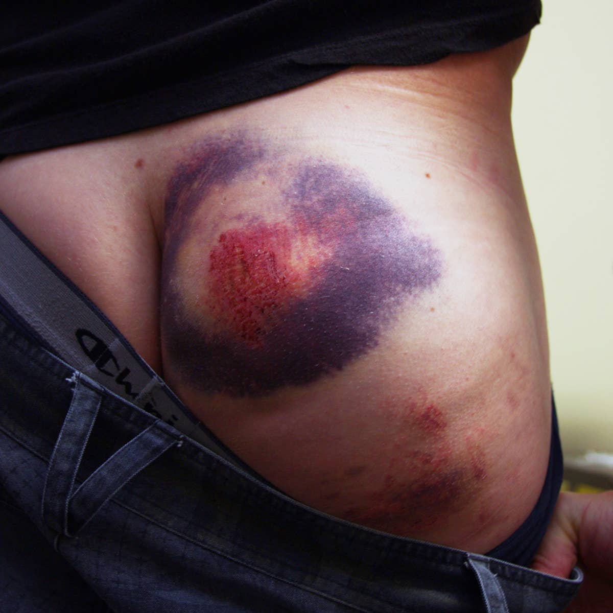 Bikemag's big-ass bruises contest - BikeMag