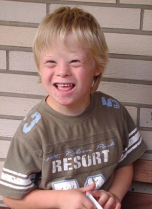 310px-Boy_with_Down_Syndrome.JPG