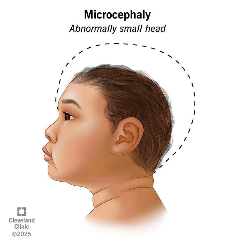9843-microcephaly