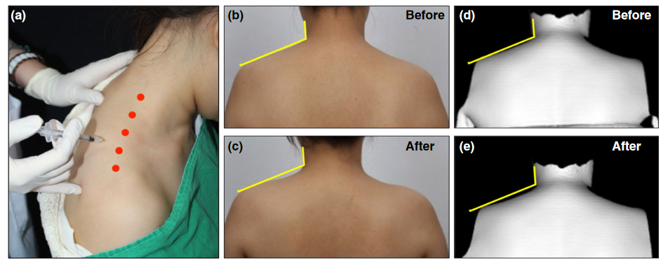 trapezius-botox-injection-korea.jpg