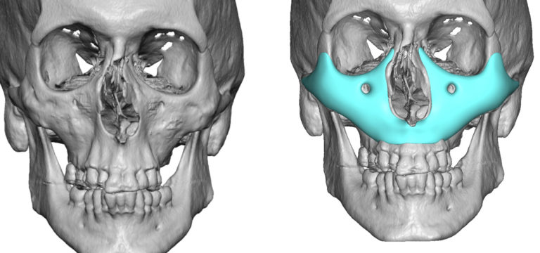 Cusyom-Midface-Mask-Implant-design-front-view-Dr-Barry-Eppley-Indianapolis-768x360.jpg