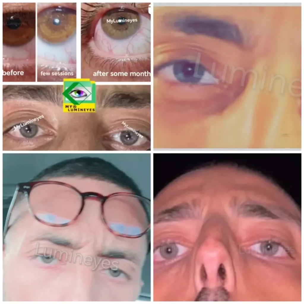 Laser Iris Depigmentation: Technical Mechanism & Safety