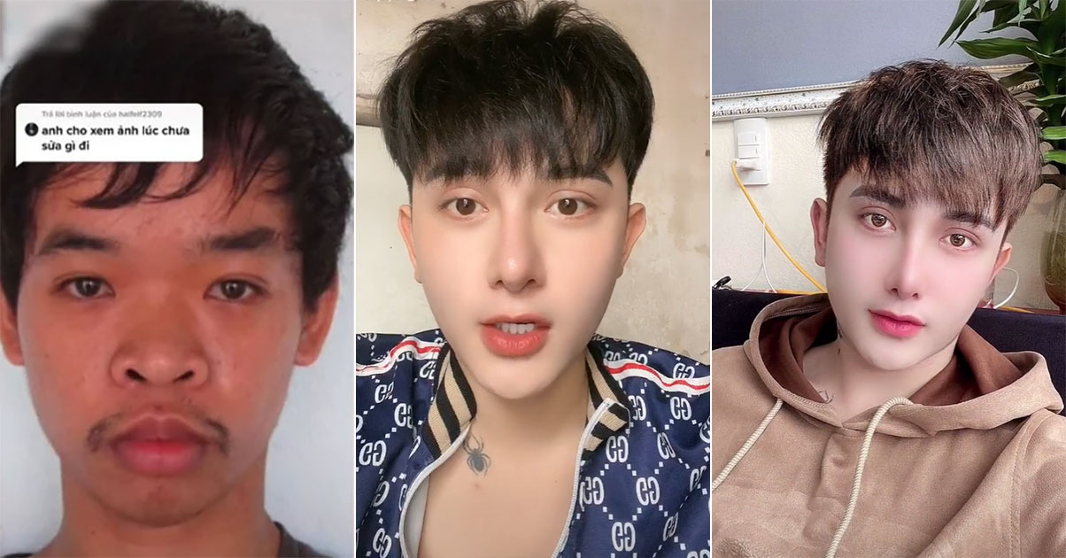 Vietnamese man, 26, undergoes radical plastic surgery after getting mocked  by job interviewer - Mothership.SG - News from Singapore, Asia and around  the world