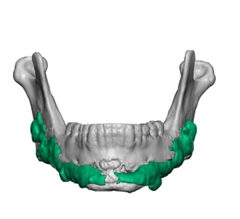 Hydroxyapatite-Jawline-Augmentation-Dr-Barry-Eppley-Indianapolis.jpg