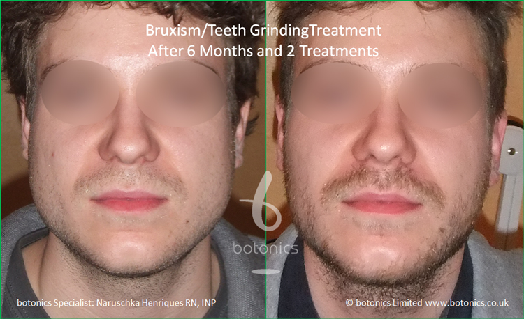 bruxism_male_botox_teeth_grinding_jaw_clenching_masseter_jaw_reduction_treatment_before_and_after_botonics_naruschka_henriques_1.jpg