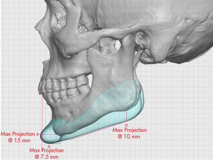 Fig-3a-Jawline-Implant-Design-side-view.jpg
