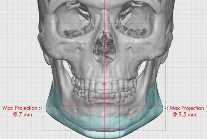 Fig-3b-Jawline-Implant-Design-front-view.jpg