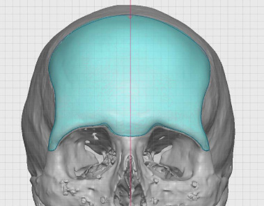 Fig-8a-Forehead-Implant-Design-front-view.jpg