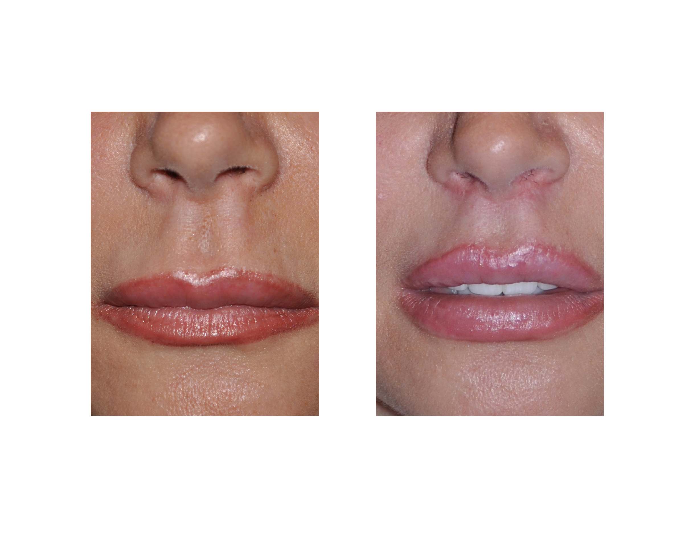 Lip-Lifts-Indianapolis-Dr-Barry-Eppley.jpg