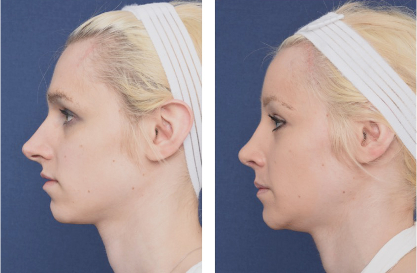 brow-bone-reduction-type-1-before-and-after.jpg