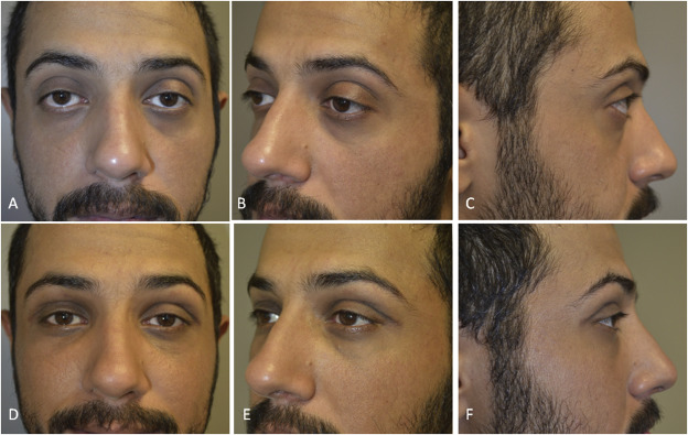 Combined orbital decompression and lower eyelid retraction surgery ...