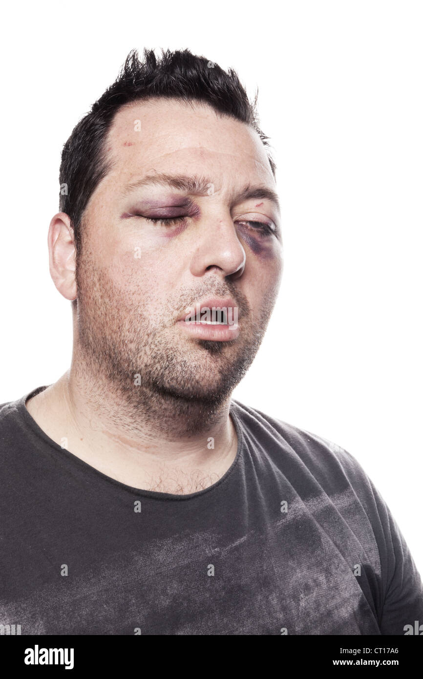 eye-injury-male-with-black-eye-isolated-on-white-man-after-accident-CT17A6.jpg