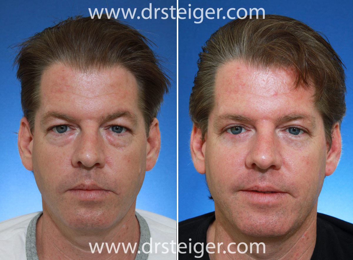 Blepharoplasty Eyelid Surgery Photos Before and After | Steiger ...