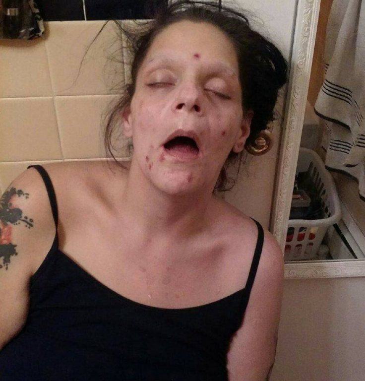 Recovering Addict Reveals Face Of Addiction, Shows Physical Effects Of Drug  Abuse And Recovery