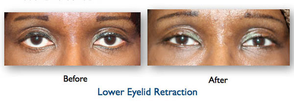 Eyelid-complication-for-images-lower-eyelid-retraction-copy.035.jpg