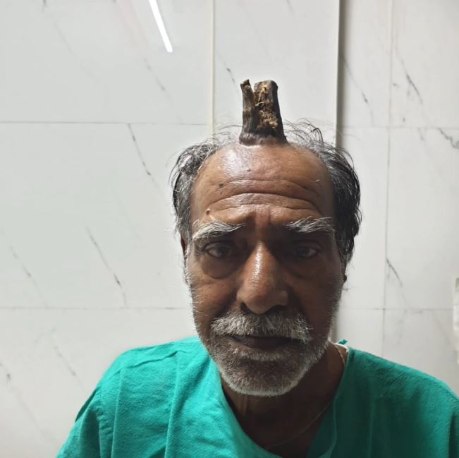 The Mysterious Case Of An Indian Man And His 'Devil Horn' | News | Rojak  Daily